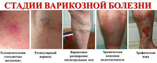 Вызов флеболога на дом Вызов флеболога на дом варикоз